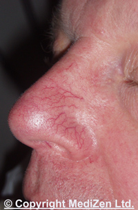 Thread veins on nose before treatment