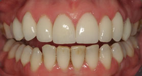 Close-up After Treatment with Cosmetic Veneers
