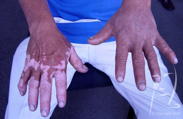 Vitiligo on hands, before and after skin camouflage