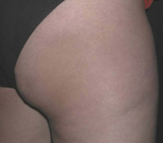 Cellulite after treatment with Accent RF