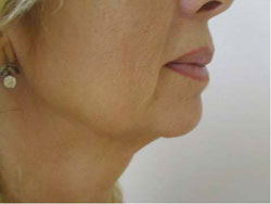 Face after treatment with Accent RF