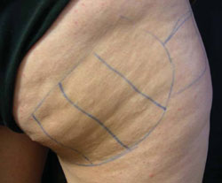 Cellulite before treatment with Accent RF