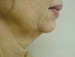 Face before treatment with Accent RF