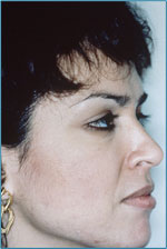Acne after microdermabrasion treatment
