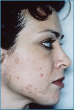 Acne before microdermabrasion treatment