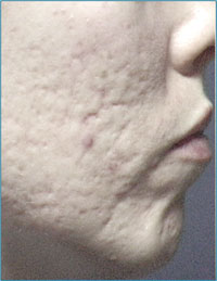 Acne Scarring Before Microdermabrasion