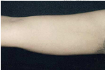 Upper Arm After Laser Lipolysis Treatment