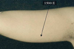 Upper Arm Before Laser Lipolysis Treatment