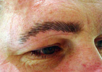Eyebrow redefinition with micropigmentation