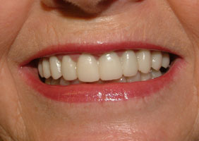 Close-up After Treatment with Cosmetic Correction of Crowns and Gum Contouring