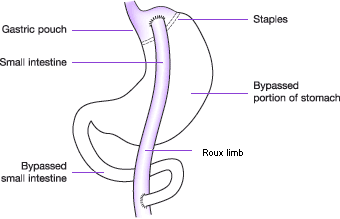 Roux-en-Y Gastric Bypass Operation