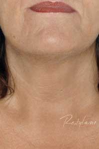 Neck after treatment with RESTYLANE® Vital hspace=