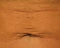 Abdomen (tummy) 1 month after Titan treatment