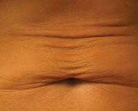 Abdomen (tummy) before Titan treatment