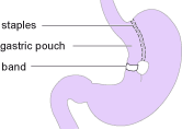 Vertical Gastric Band Operation
