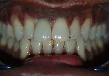 The end result of having a single Dental Implant