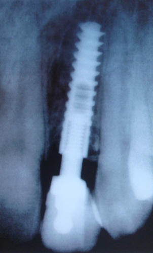 An Xray of the Dental Implant within the mouth