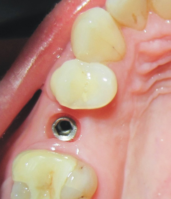 Dental Implant fitting within the mouth
