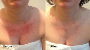 Eczema before and after using dermalux