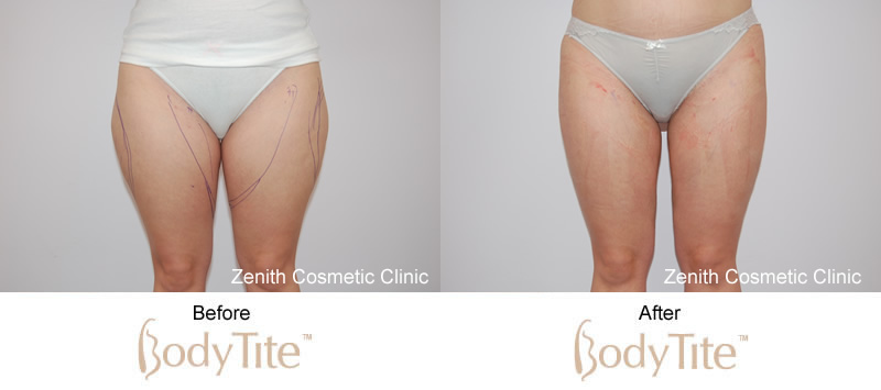 BodyTite before and after thighs